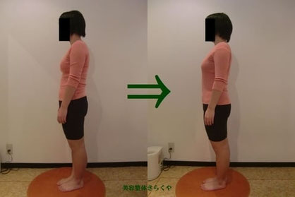 (結果には個人差があります。施術6回・期間2ヶ月)