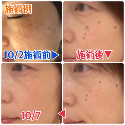 シミに悩む全ての方に シミデトックス 栃木県栃木市エステサロン チューラ