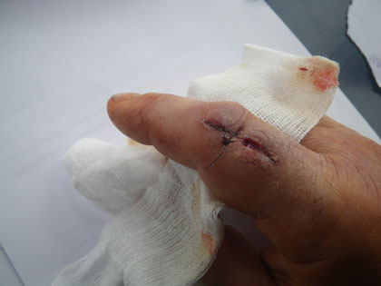 Verletzter Finger 4 Tage nach dem Stich.