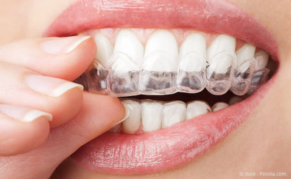 Transparente Folie für die Zahnregulierung statt Zahnspangen mit Invisalign