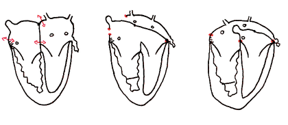 Intervention de Senning : les traits rouges montrent les zones d’incision et le remaniement effectué pour rediriger le flux cave vers le ventricule gauche
