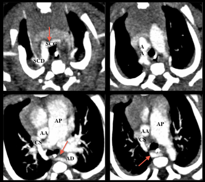 Exemple d'anomalie complexe des arcs aortiques avec hypoplasie d'une crosse aortique droite