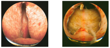 adenoma bilobato prostatico)