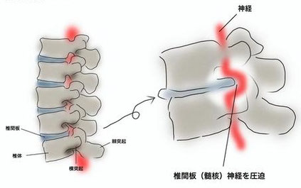 腰椎椎間板ヘルニアの説明