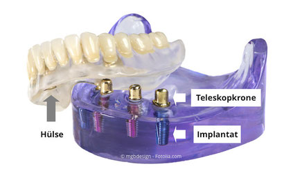 Modell mit Implantaten und Prothese