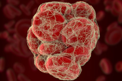 Thrombose