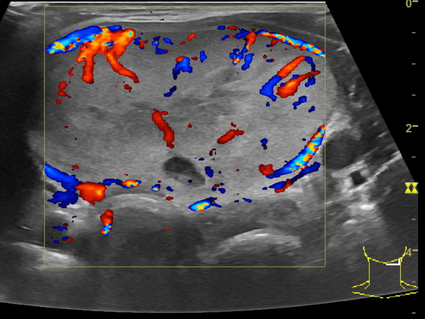 Beurteilung der Durchblutung eines soliden Schilddrüsenknotens mittels Duplex-Sonographie.