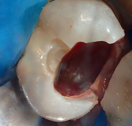We can fix infected teeth, we take your insurance