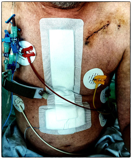 Herztransplantation: Erfahrungsbericht
