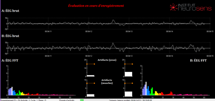 evaluation eegq, TDA, dys, enfant hyperactif, TDA/H adulte, neurofeedback EEGq, dépression, anhédonie, stress, burn out