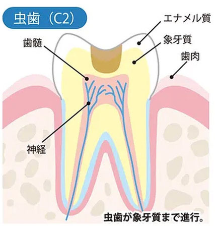 象牙質まで進行した虫歯