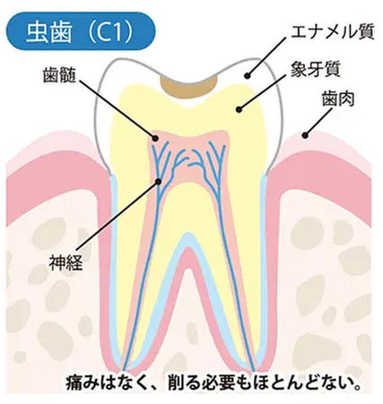 エナメル質の虫歯