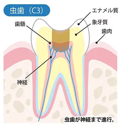 神経まで達した虫歯