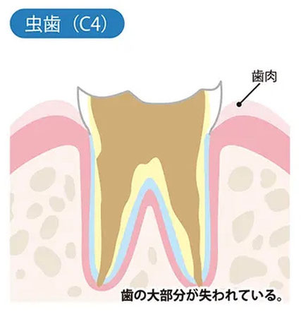 歯がほとんど残っていない虫歯