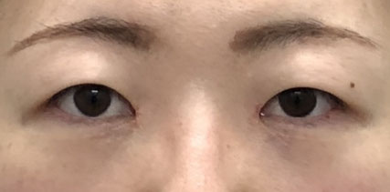 目頭切開の画像