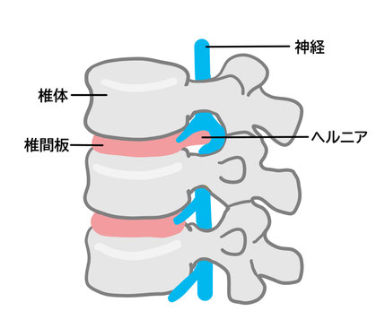 腰椎椎間板ヘルニア 福山市/整体