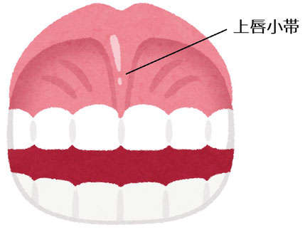 上唇小帯