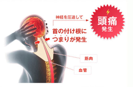 首の付け根に詰まりが発生すると、神経を圧迫して頭痛が発生します。筋肉や血管が圧迫され、血流が悪くなってしまいます。