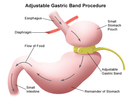 Virtual Gastric Band Weight Loss Program