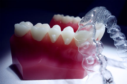 Invisalign® Zahnbegradigung / Zahnkorrektur - Zahnarztpraxis Dr. Ulrike Guder in Hamburg-Stellingen