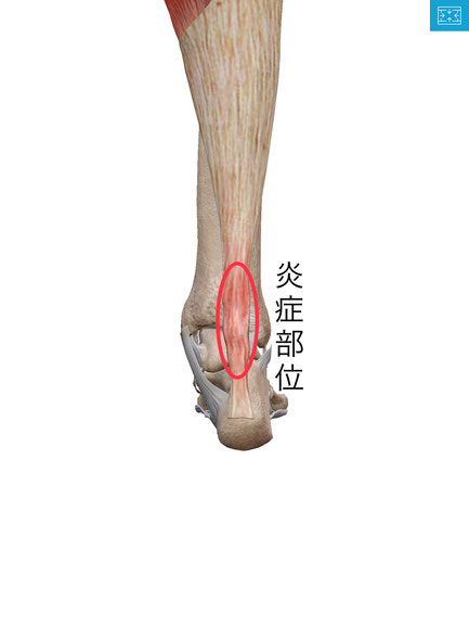 アキレス腱の痛み　陸上