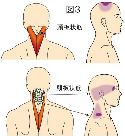 頭板状筋・頚板状筋トリガーポイントによる痛みとしびれの領域