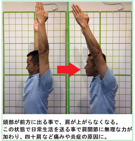 佐倉市かぶらぎ整骨院・整体院 頭部が前方に出る事で両手が上がりにくくなるイメージ画像