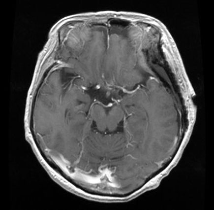 右目がほぼ失明した状態で手術を行なった６２歳女性の髄膜腫の症例　術後頭部MRI画像