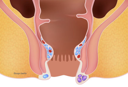 Anal vein thrombosis - proctology berlin