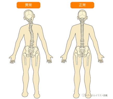 骨のズレ　異常　正常