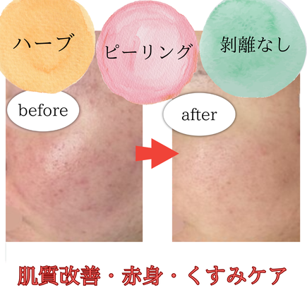 ハーブピーリングで肌質改善　ビフォーアフター