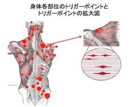 松戸　柏　三郷　市川　トリガーポイント　千葉　鍼灸　MPS　頭痛　整形外科