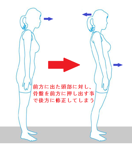 かぶらぎ整骨院・整体院ブログ 頭部前方変位・骨盤を前方に押し出すイメージ画
