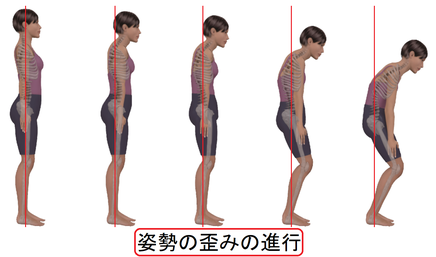 かぶらぎ整骨院・整体院ブログ 姿勢の歪みの進行イメージ画