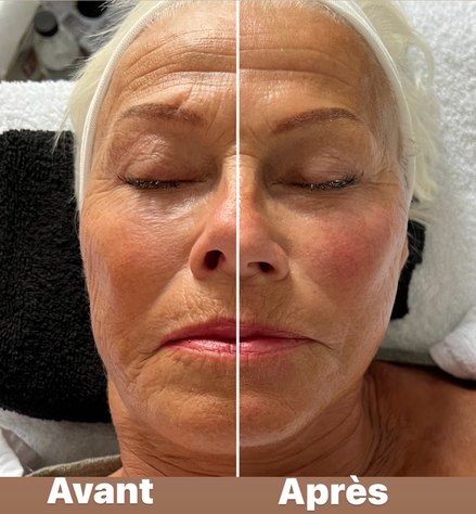 Résultats Avant/Après HIFU visage complet: lifting naturel où les ultrasons stimulent la production de collagène et élastine les semaines qui suivent la séance. Peau liftée, plus lumineuse et pores resserrés. Effets immédiats anti-âge et progressifs