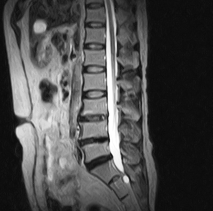 椎間板ヘルニア7 こまごめ腰痛治療室 腰痛専門の当院へお任せ下さい