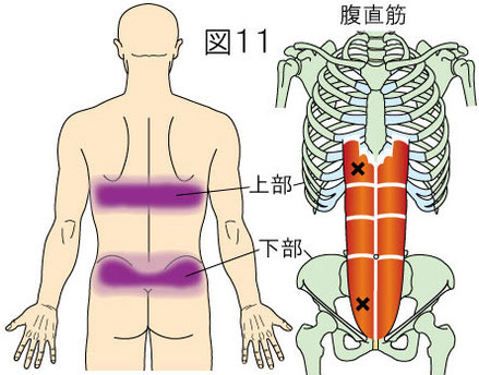 腹直筋上部と下部トリガーポイントによる背中の痛みと腰痛