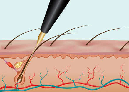 electrolysis, permanent hair removal, hair free, smooth skin, forever, no more hair