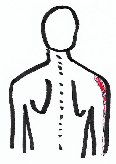 Therapie von Schulterschmerzen