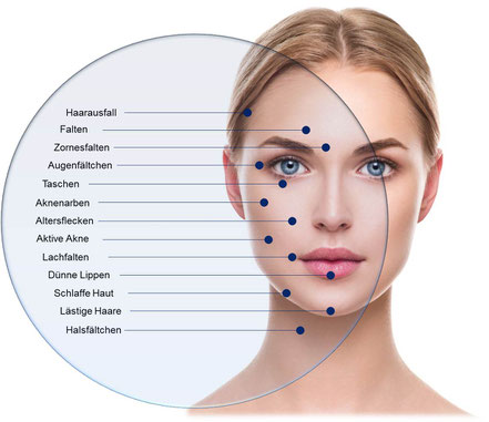 Microneedling beschreibung der Methode 