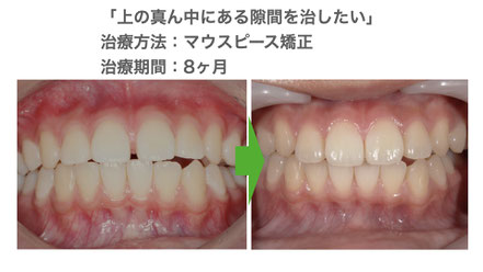 マウスピース矯正部分矯正