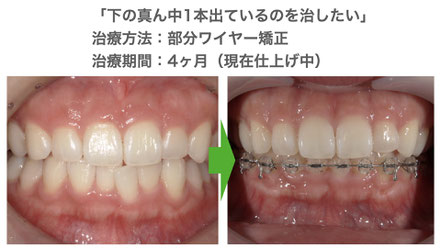 ワイヤー矯正部分矯正