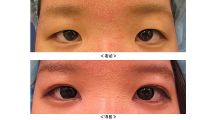 小川医師による眼瞼手術症例写真 Shiromoto Ogawa ページ