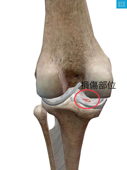 膝の痛み　半月板損傷