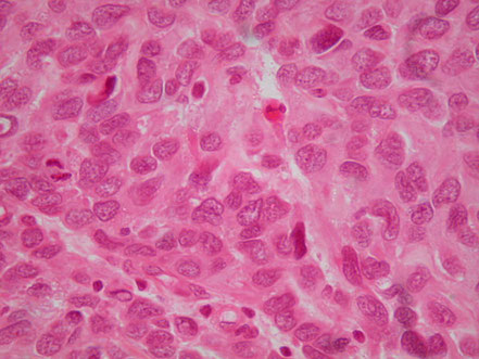 RHABDOMYOSARCOME
