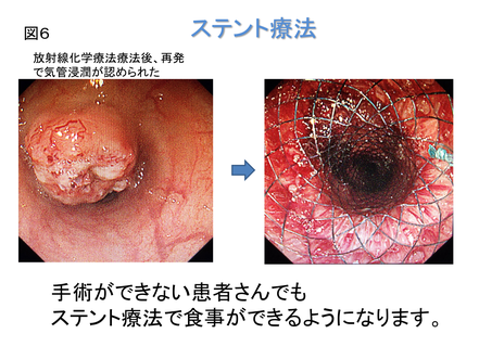 福岡での食道がんのロボット手術・胸腔鏡手術はこちらへ - 福岡