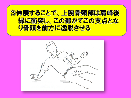 肩関節脱臼について 前方脱臼論 氷見市本町 高崎接骨院