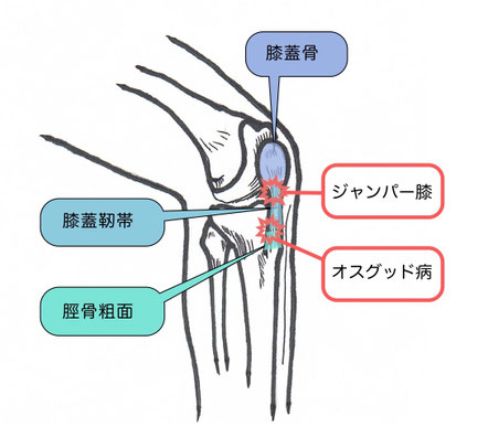 膝蓋靭帯炎