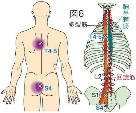 多裂筋トリガーポイントによる背部の痛み　半棘筋・多裂筋・回旋筋の走行図