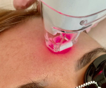 Lasemd ™ Pigmentflecken und Verkleinerung Poren und Glow Arzt Praxis Silke Ebert München